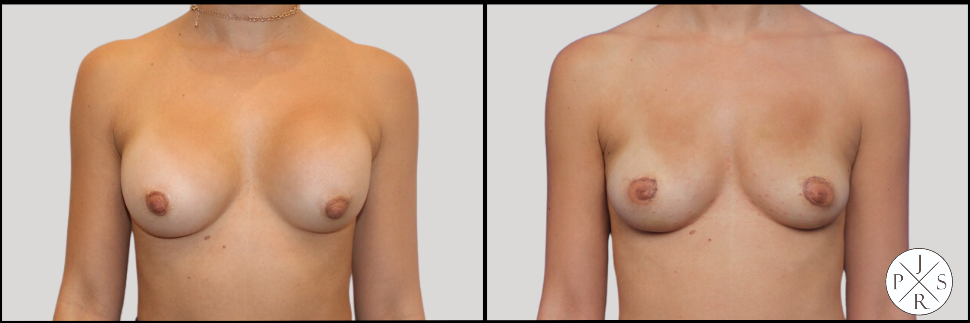 Breast Implant Removal Before & After Image